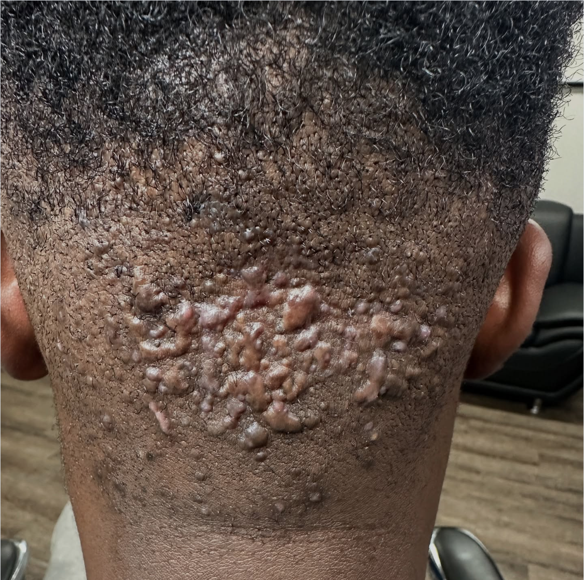 Back of the Neck Bumps After a Haircut: What's Really Causing Them